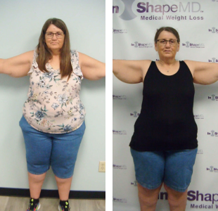 Before and after weight loss pictures of a woman with her arms up on the side