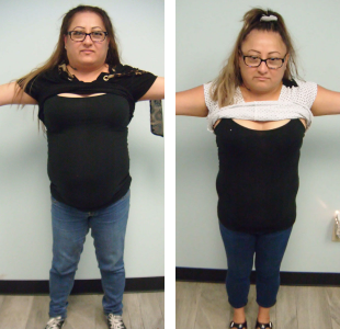 Before and after weight loss pictures of a woman with her shirt up