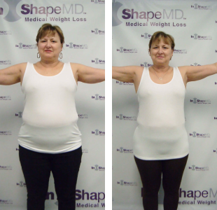 Before and after weight loss pictures of a woman with her arms up