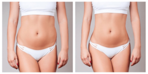 https://inshapemdtx.com/wp-content/uploads/2023/04/fat-dissolving-injection-body-before-and-after-min-300x150.png