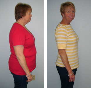 A Before and After Image Showing a Woman Before and After Prescription Appetite Suppressants